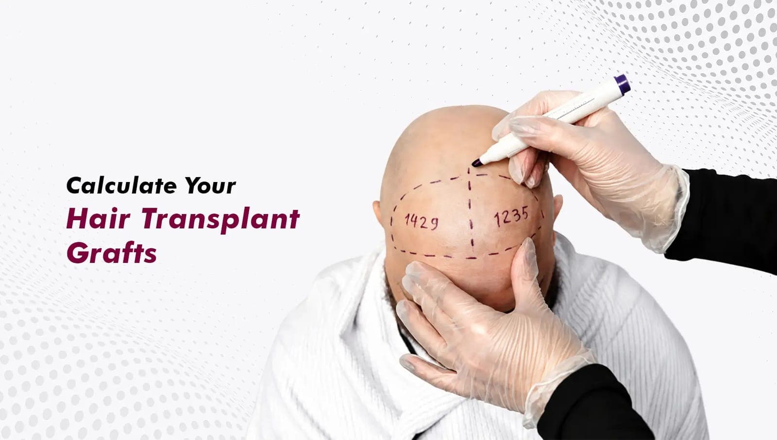 Hair Transplant in Gurgaon: Complete Guide to Hair Restoration